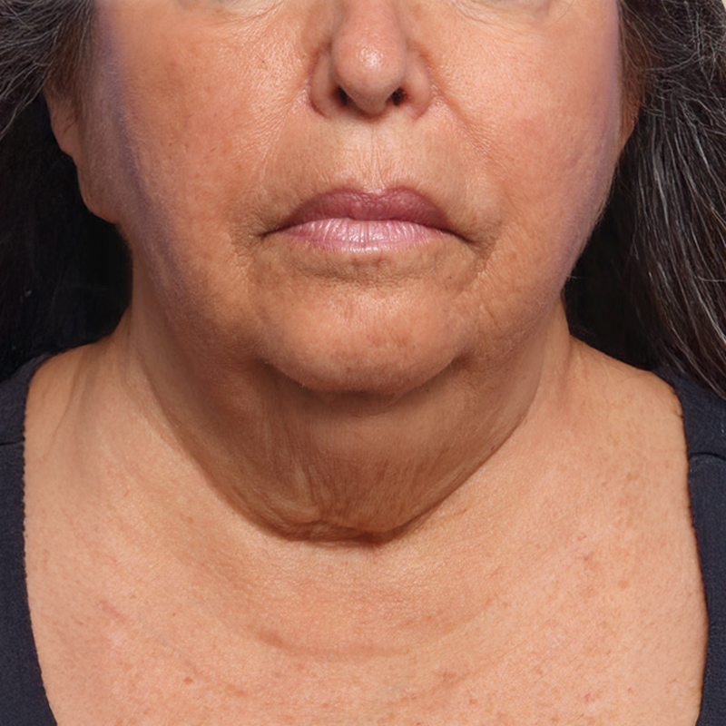 Chin before and after - before