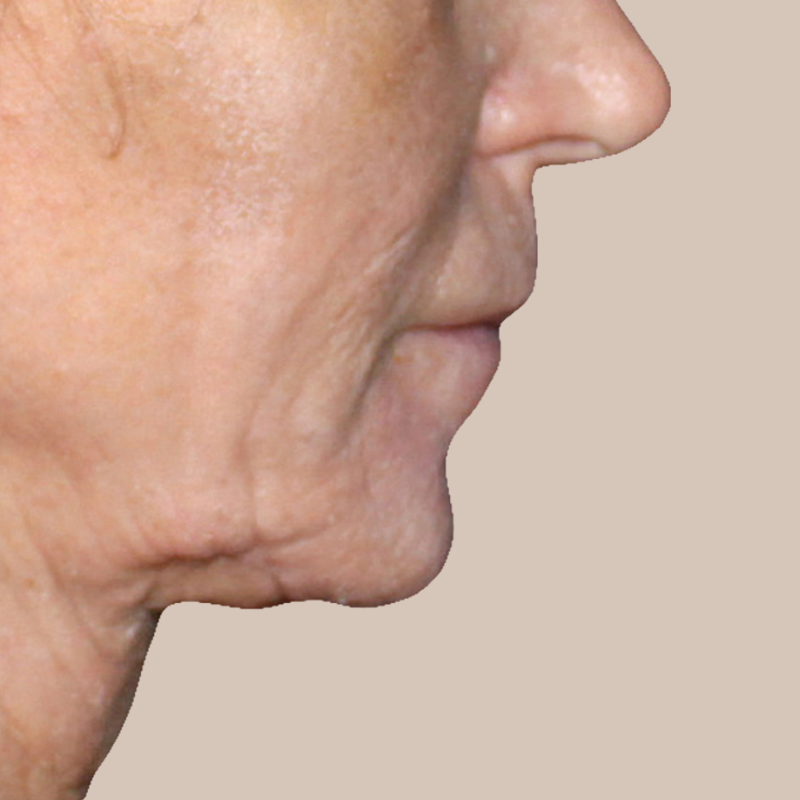 Chin before and after - before