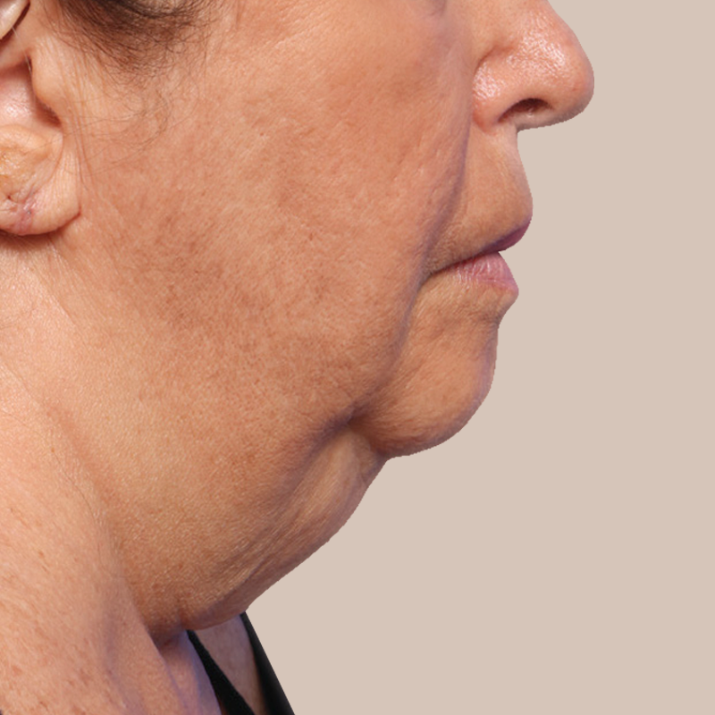 Chin before and after - before