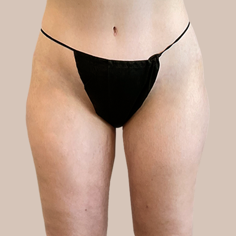 Thighs Airtite Female before and after - before