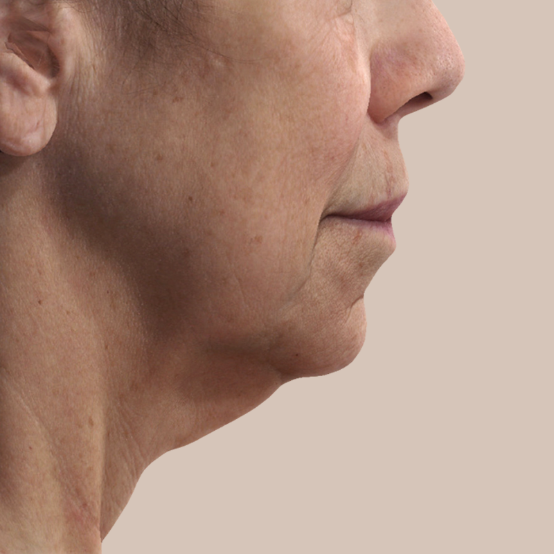 Chin before and after - before