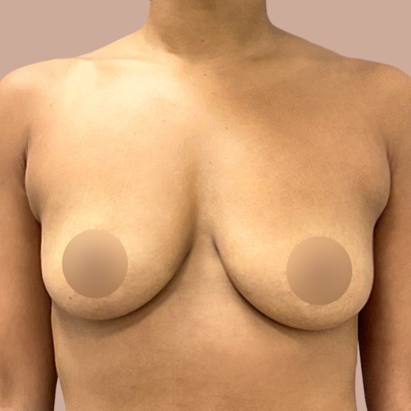 Fat Transfer Breast Augmentation before and after - before