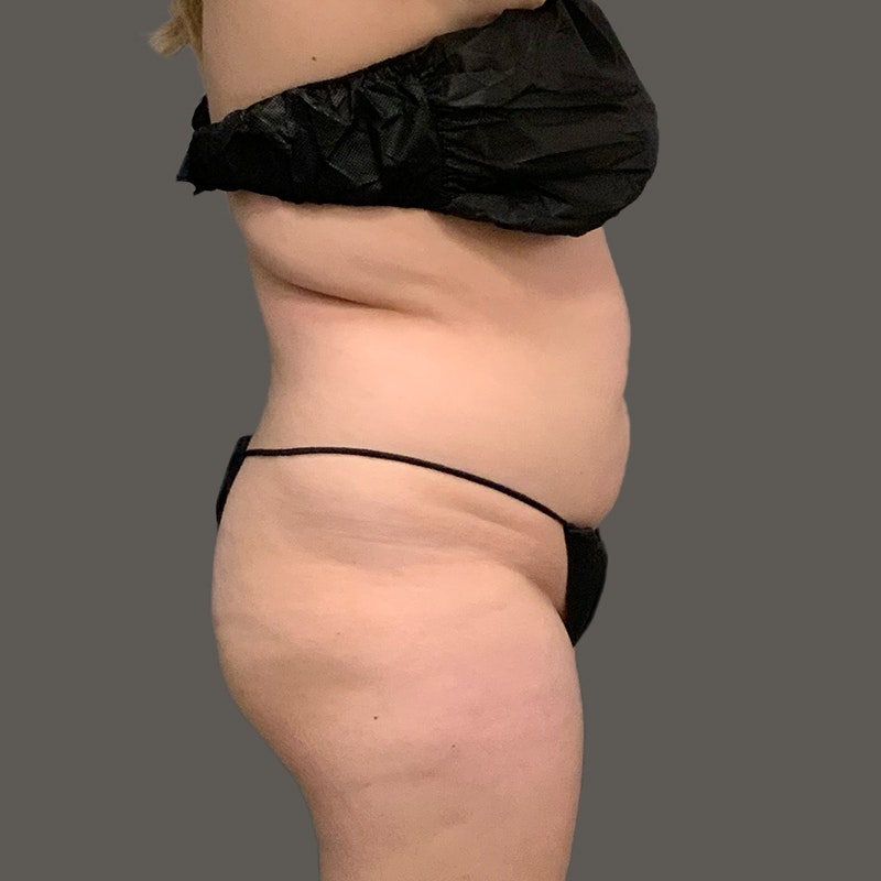 AirSculpt® before and after - before