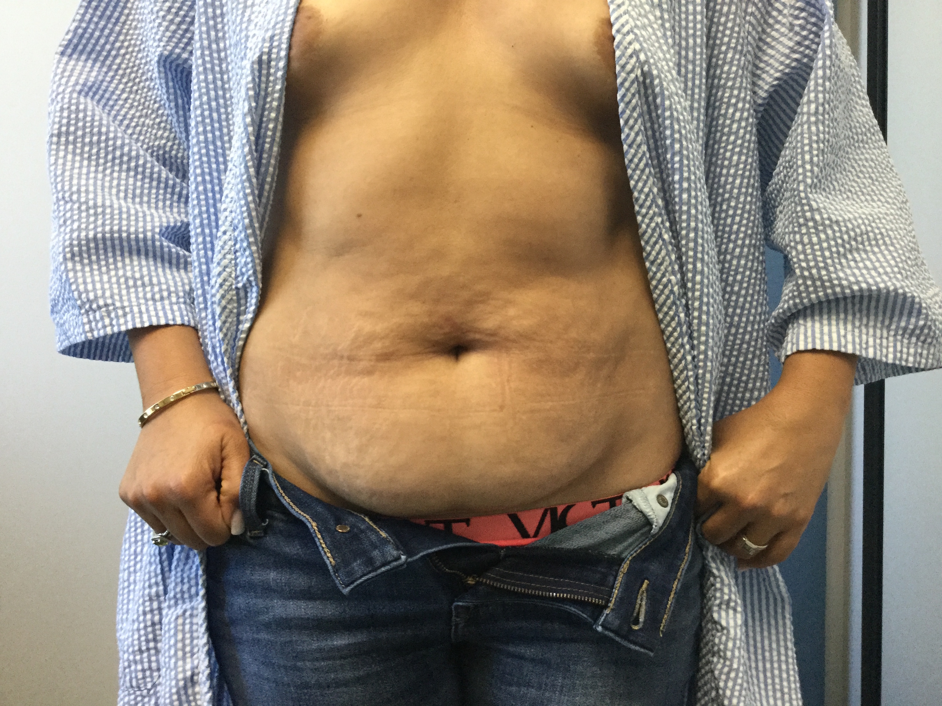 Bilateral Breast Augmentation and Abdominoplasty before and after - before