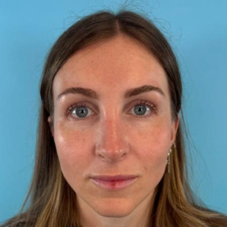 Nose Surgery before and after - after