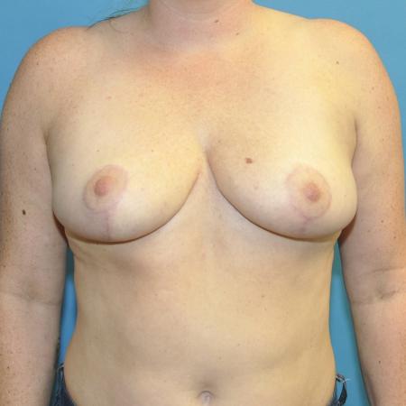 Breast Reduction and Bra Roll Liposuction before and after - after