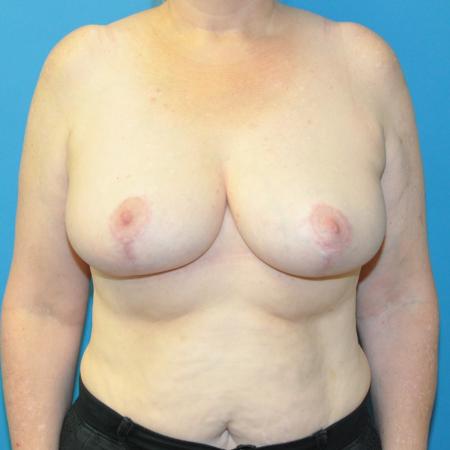 Breast Reduction before and after - after