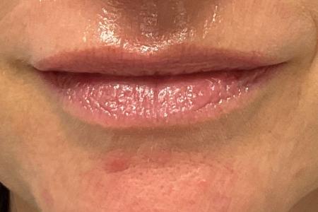 Lip Enhancement before and after - after
