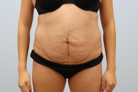 Skin Removal Surgery: Tummy Tuck with Lipo 360 before and after - before