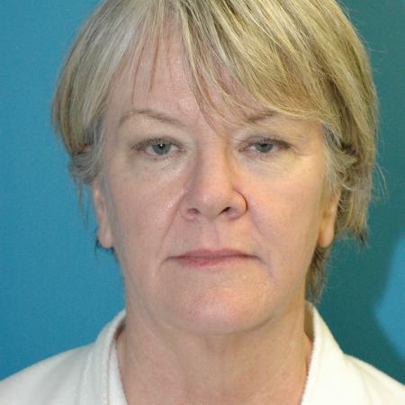 Face and Necklift before and after - before
