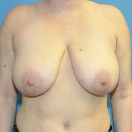 Breast Reduction and Bra Roll Liposuction before and after - before