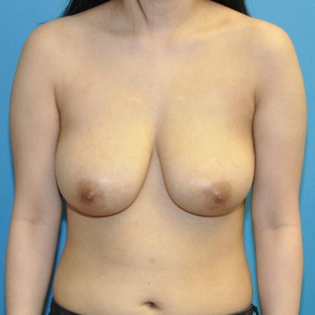 Breast Reduction before and after - before