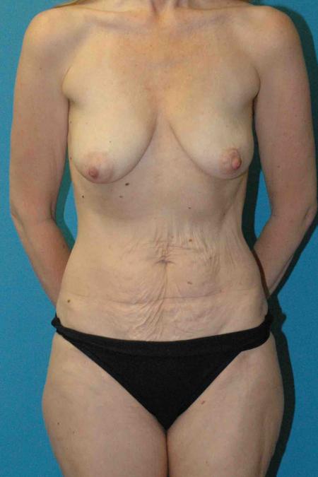 Mommy Makeover before and after - before