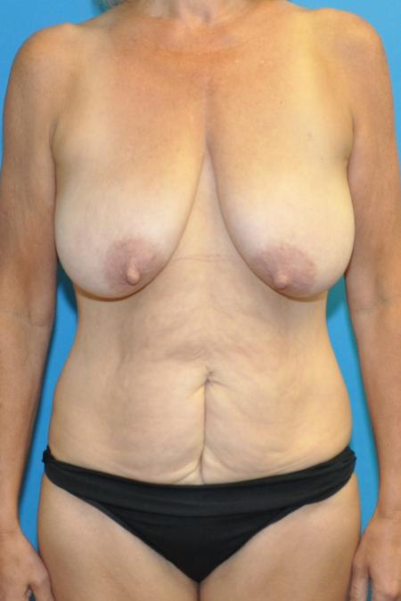 Mommy Makeover before and after - before