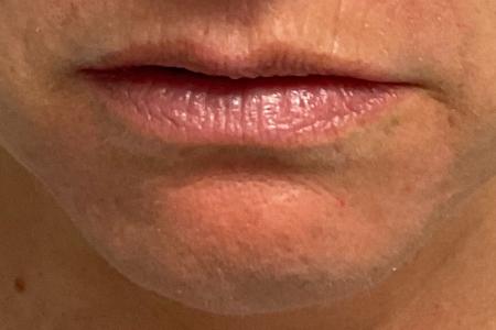 Lip Enhancement before and after - before