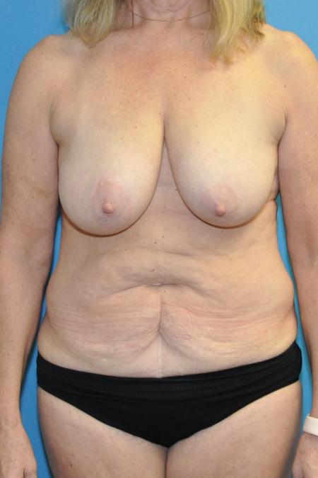 Mommy Makeover before and after - before