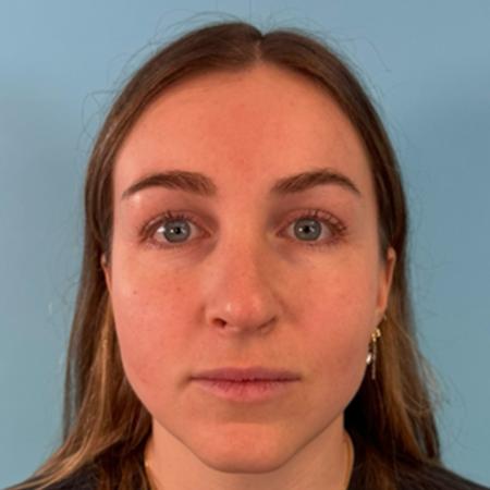 Nose Surgery before and after - before