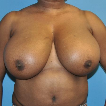 Breast Reduction before and after - before