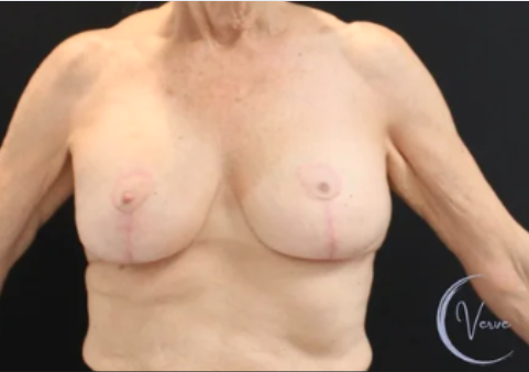 Breast Augmentation before and after - after