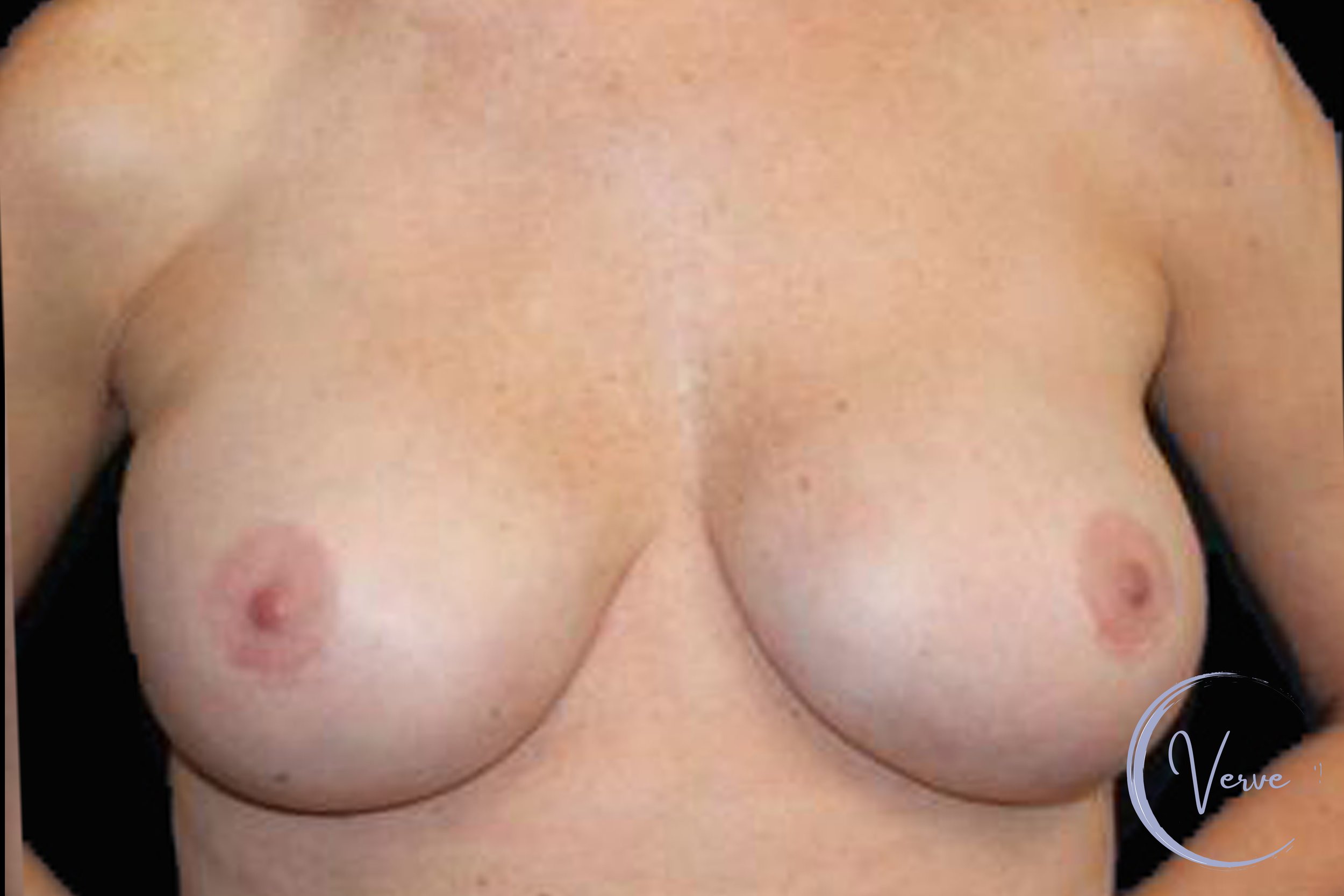 Breast Revision before and after - after