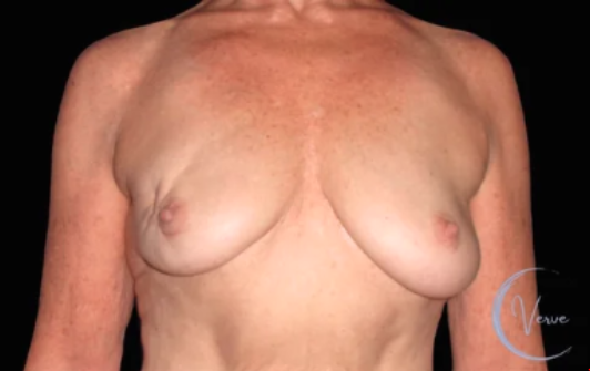 Breast Augmentation before and after - after