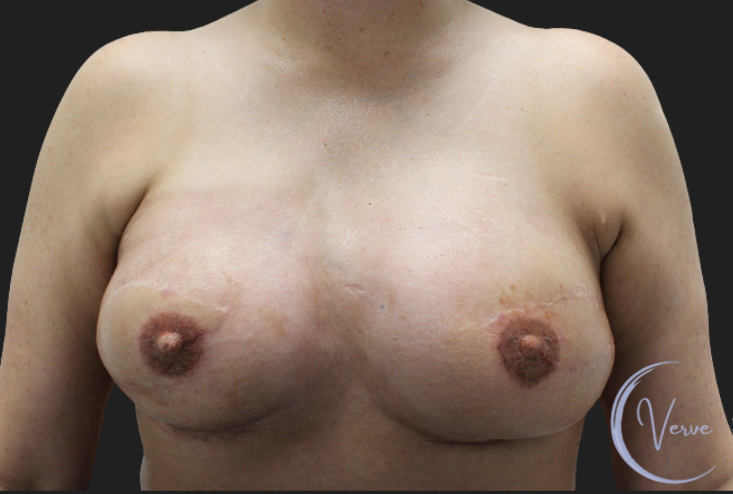 Breast Augmentation before and after - after