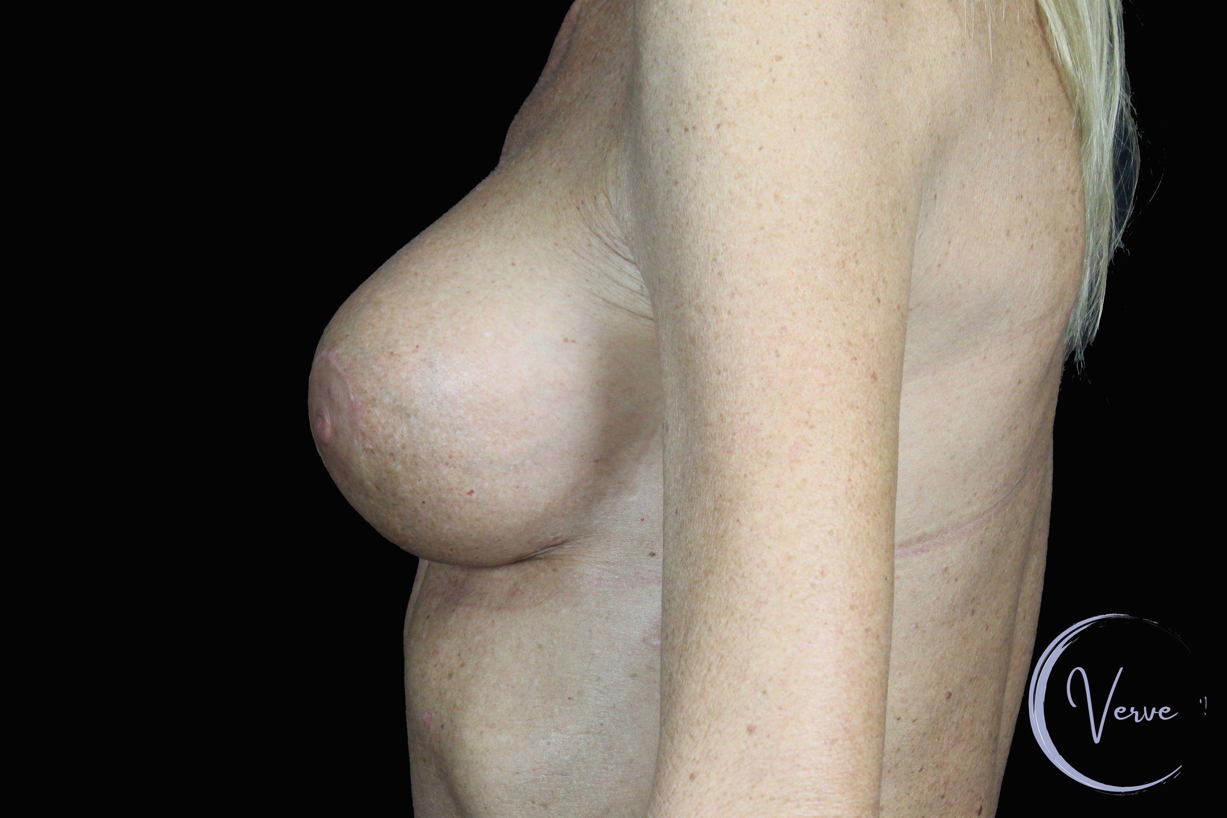 Breast Revision before and after - after