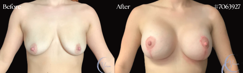 Breast Augmentation before and after - after