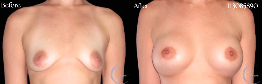 Breast Augmentation before and after - after
