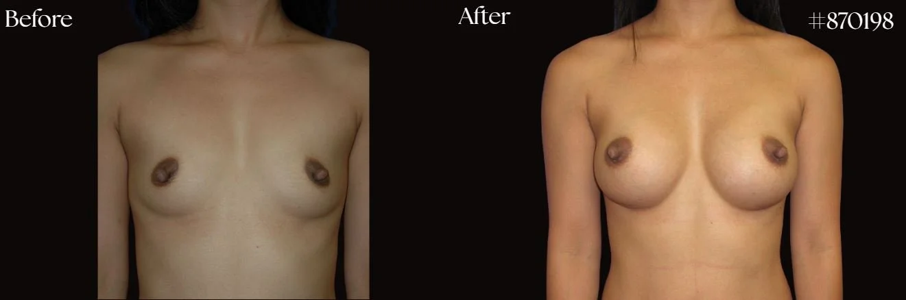 Breast Augmentation before and after - after