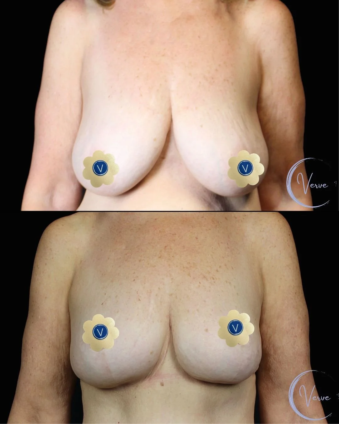 Breast Reduction by Dr. Anshu Gupta — after
