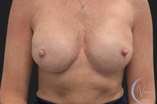 Breast Augmentation before and after - after