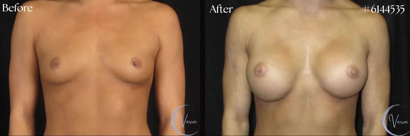 Breast Augmentation before and after - after
