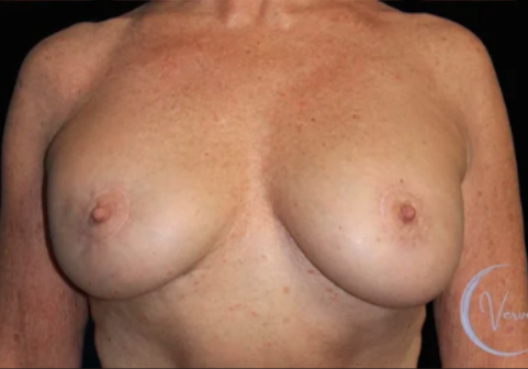 Breast Augmentation before and after - after