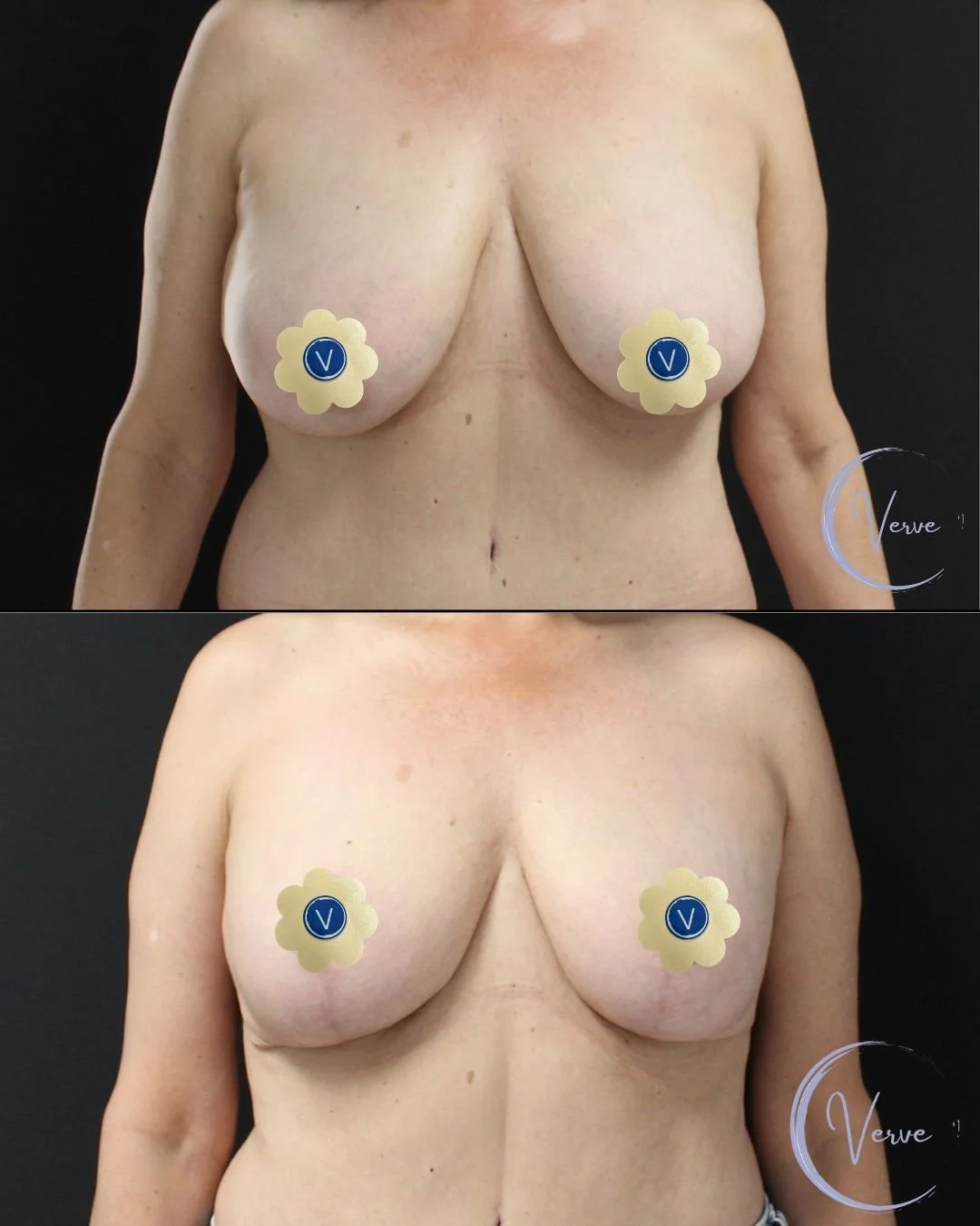 Breast Augmentation by Dr. Anshu Gupta — after