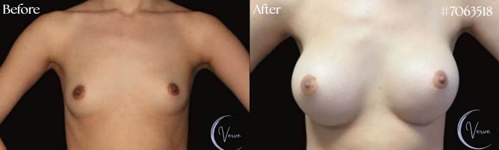 Breast Augmentation before and after - after