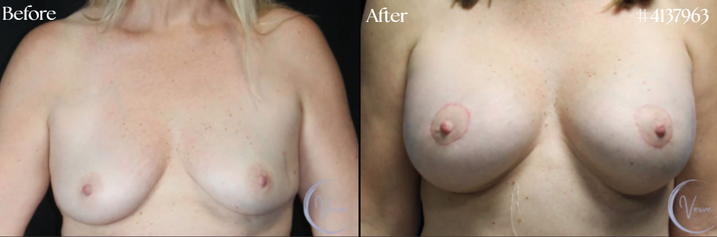 Breast Augmentation before and after - after