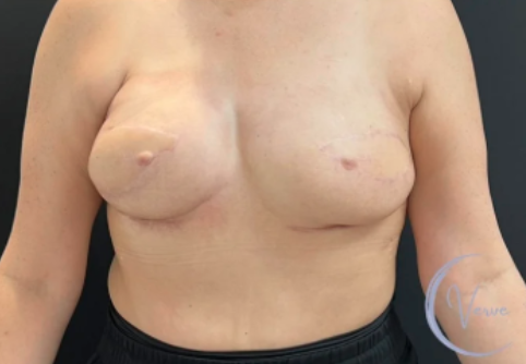 Breast Augmentation before and after - after