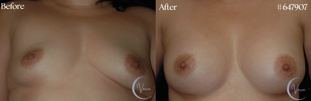 Breast Augmentation before and after - after