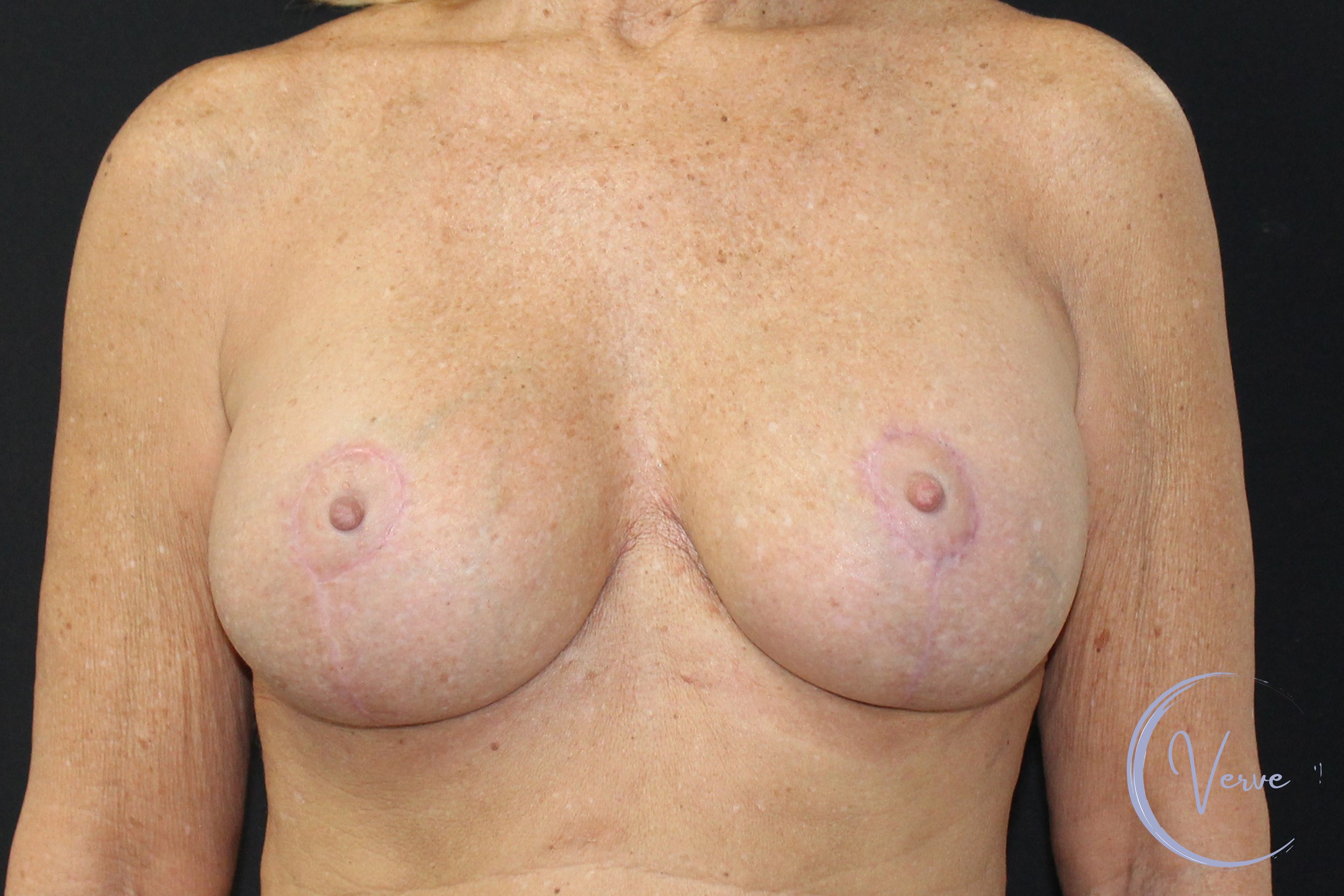 Breast Revision before and after - after
