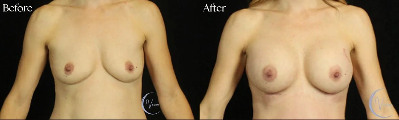 Breast Augmentation before and after - after