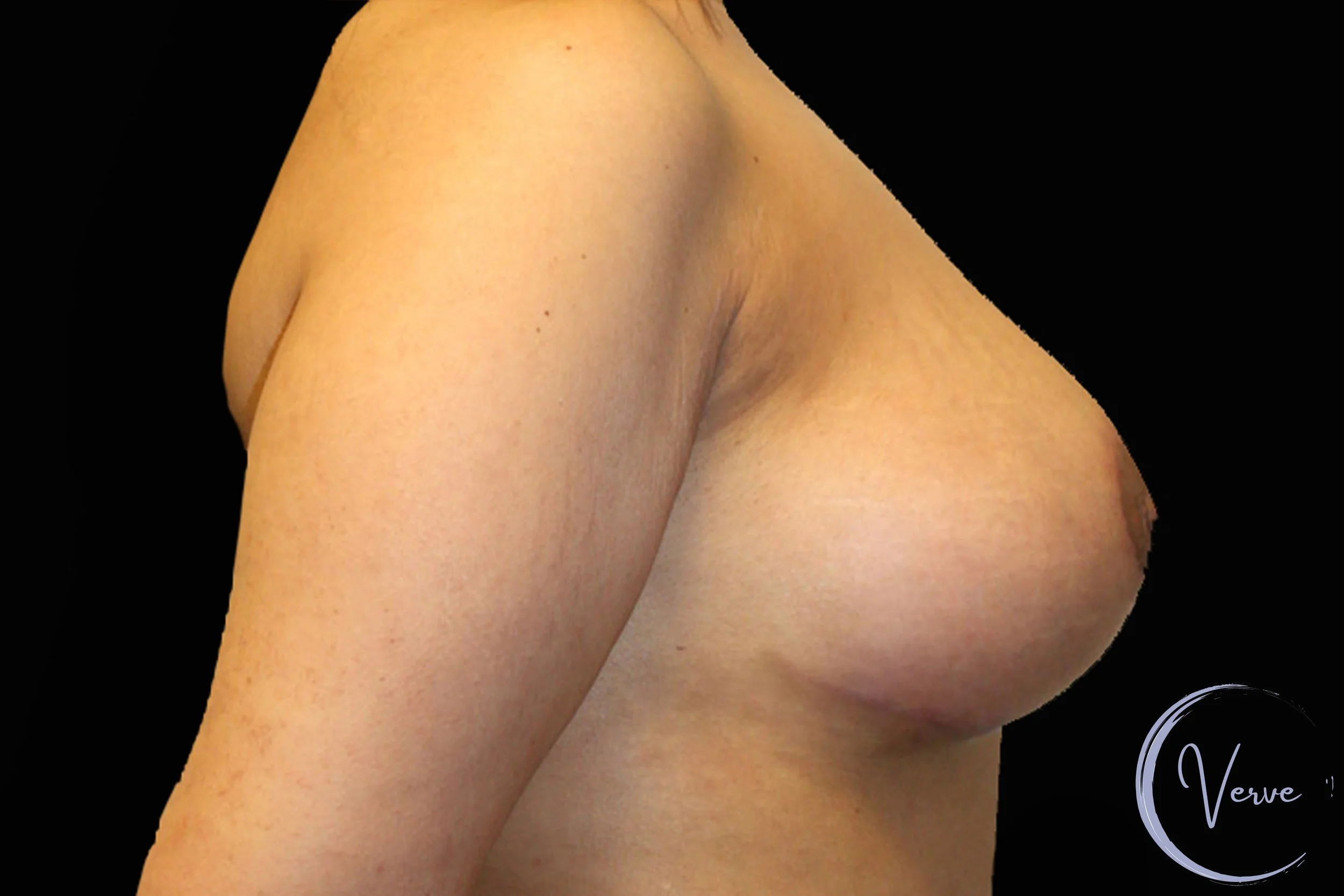 Breast Augmentation before and after - after
