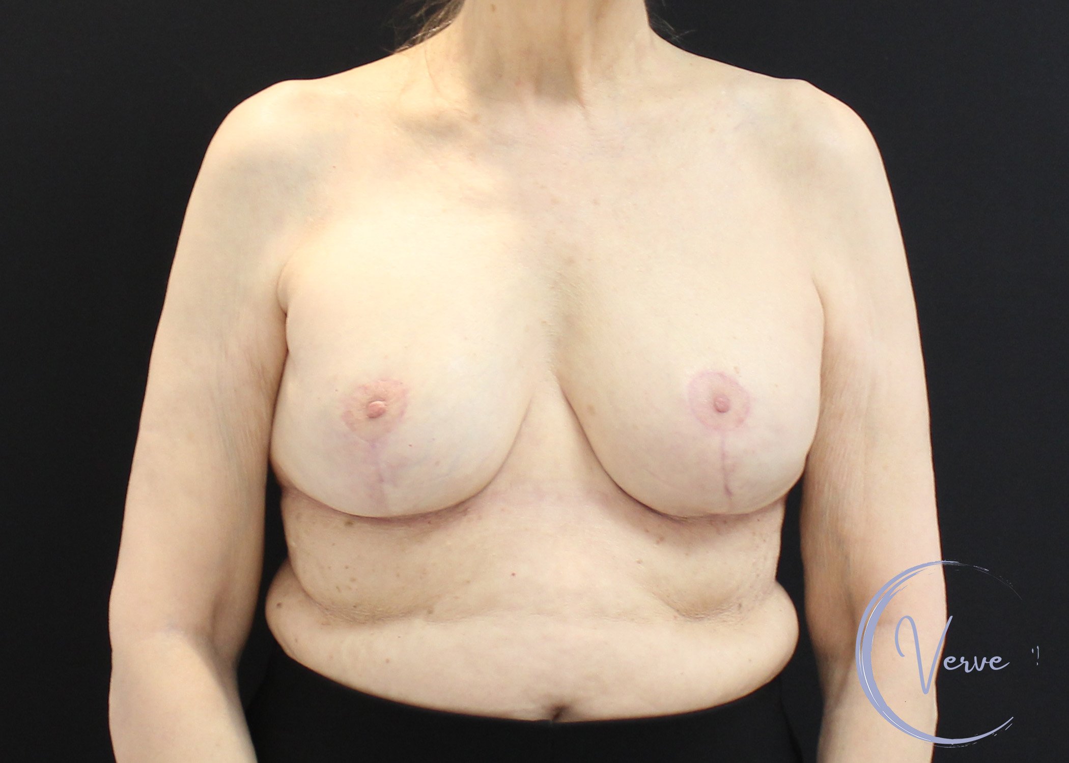 Breast Revision before and after - after