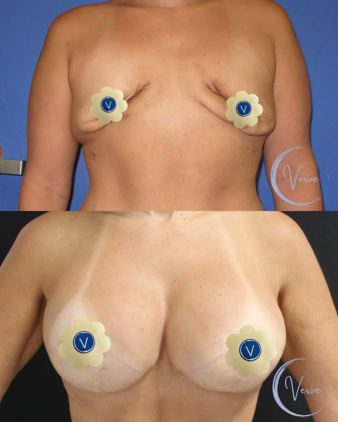 Breast Reconstruction by Dr. Anshu Gupta — before