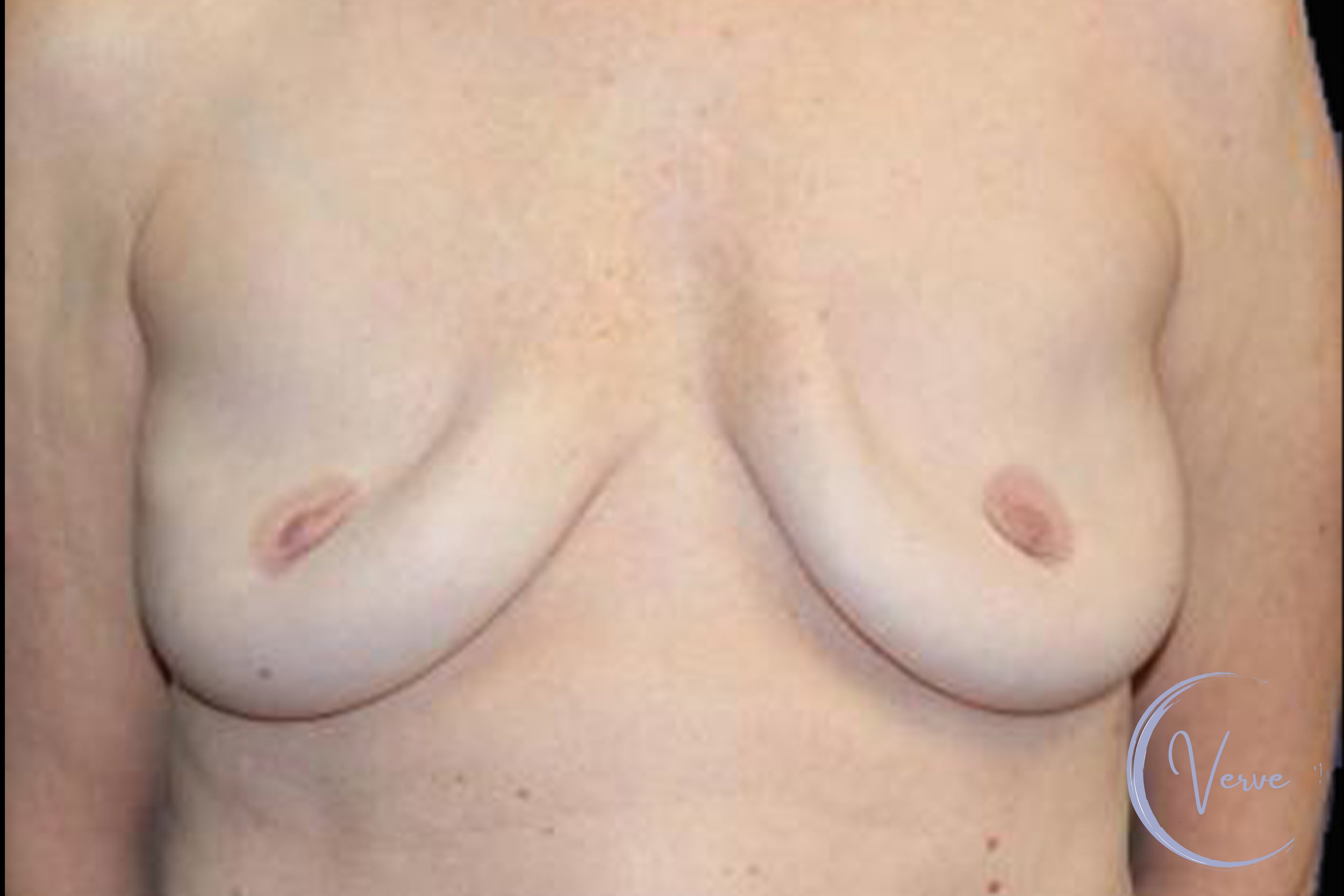 Breast Revision by Dr. Anshu Gupta — before and after