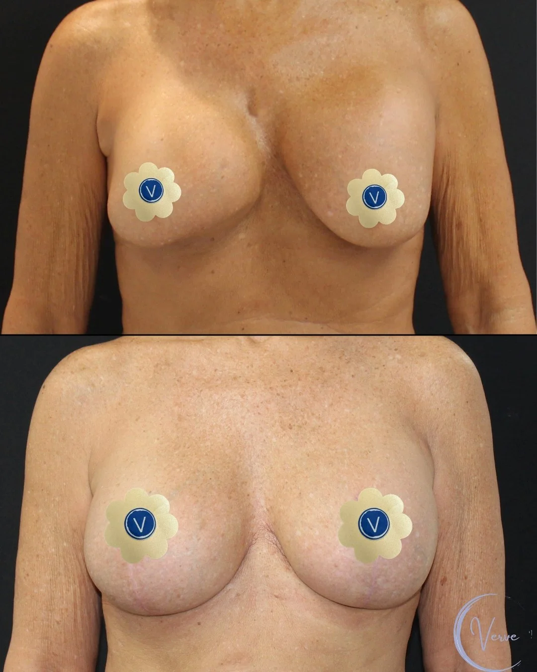 Breast Revision by Dr. Anshu Gupta — before