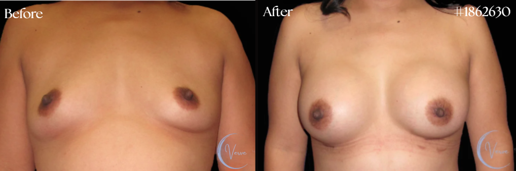 Breast Augmentation by Dr. Anshu Gupta — before and after