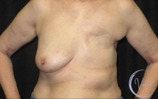 Breast Augmentation by Dr. Anshu Gupta — before and after