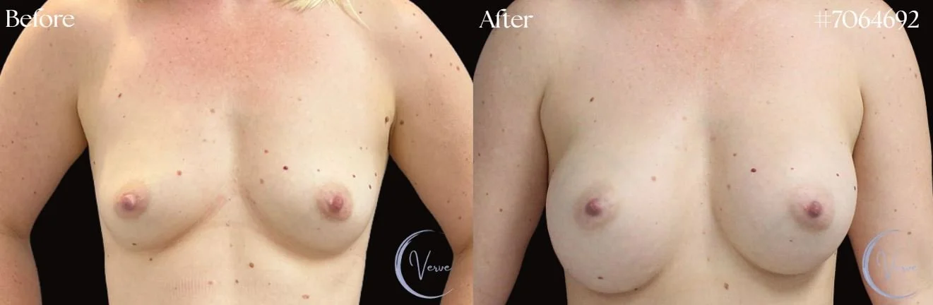 Breast Augmentation by Dr. Anshu Gupta — before and after