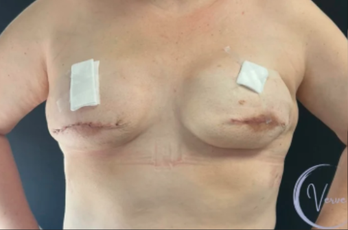 Breast Augmentation by Dr. Anshu Gupta — before and after